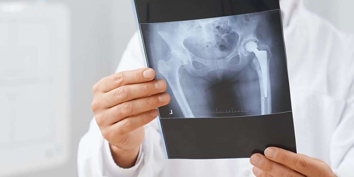 Understanding the Cost of Private Hip Replacement in Alberta
