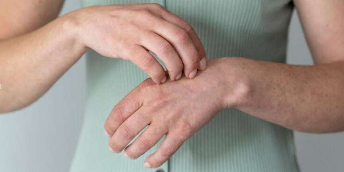 Is There A Vitiligo Cure For Long Term In Homeopathy?