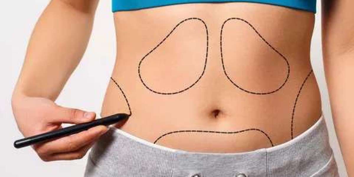 Liposuction for Women in Islamabad: Options & Expectations