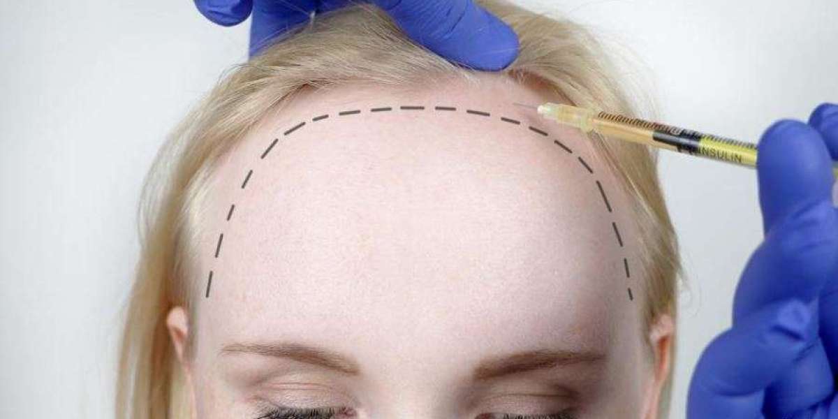 Hair Transplant Redefined: Innovative Techniques Shaping the Future of Natural Hair Restoration