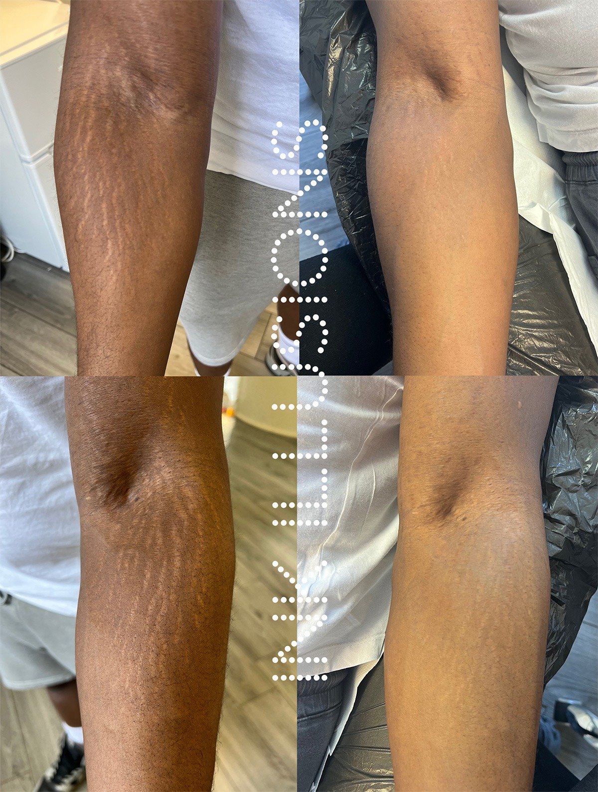How MCA Microneedling Can Help Eliminate Stretch Marks Effectively - Ink Illusions