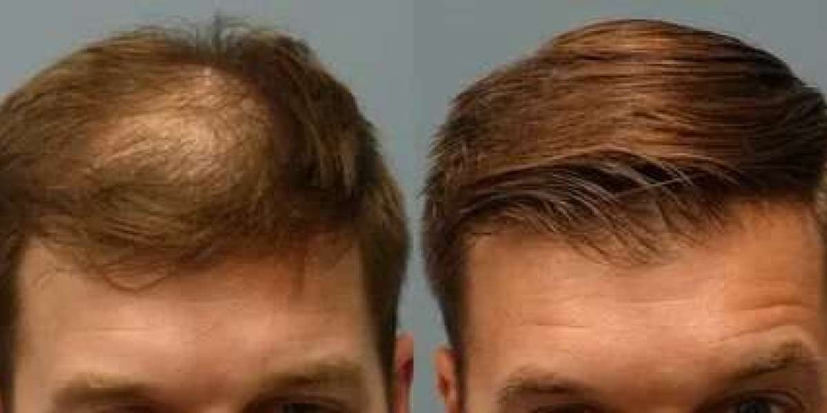 FUE Hair Transplant in Islamabad – The Modern Solution for Hair Loss