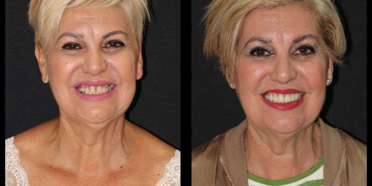 Estética Dental en Hospitalet de Llobregat Transforma tu Sonrisa