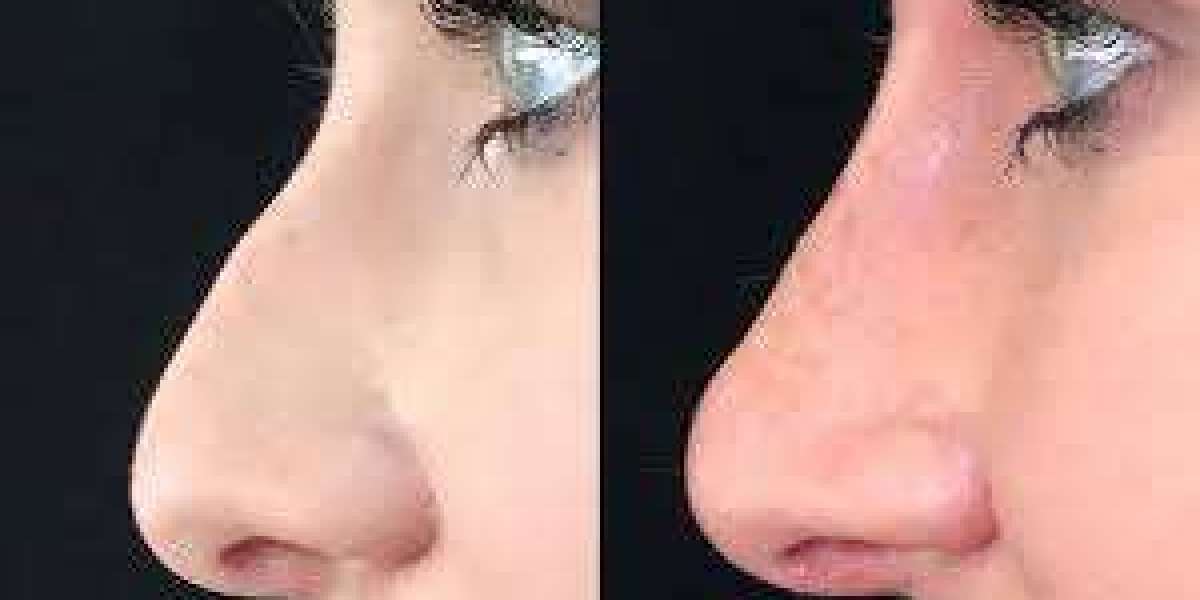 Redefine Your Beauty: Liquid Rhinoplasty Treatment in Islamabad
