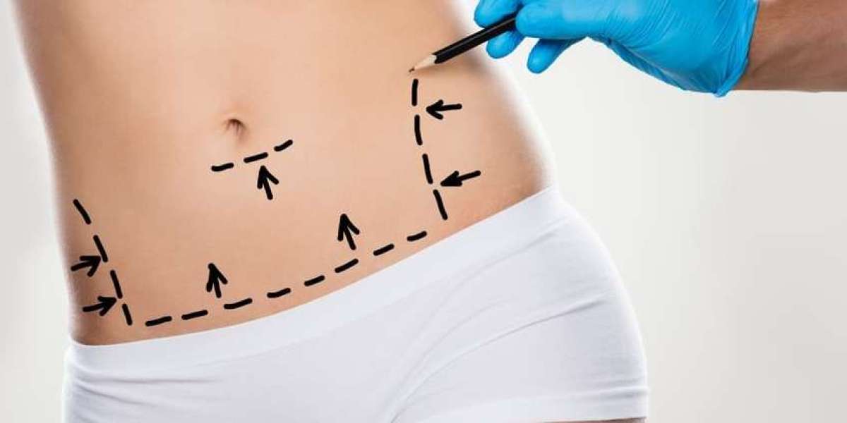 Why Abdominoplasty in Islamabad Is the Choice for Body Transformation