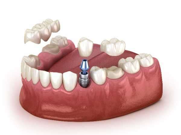 dental implant Leeds 