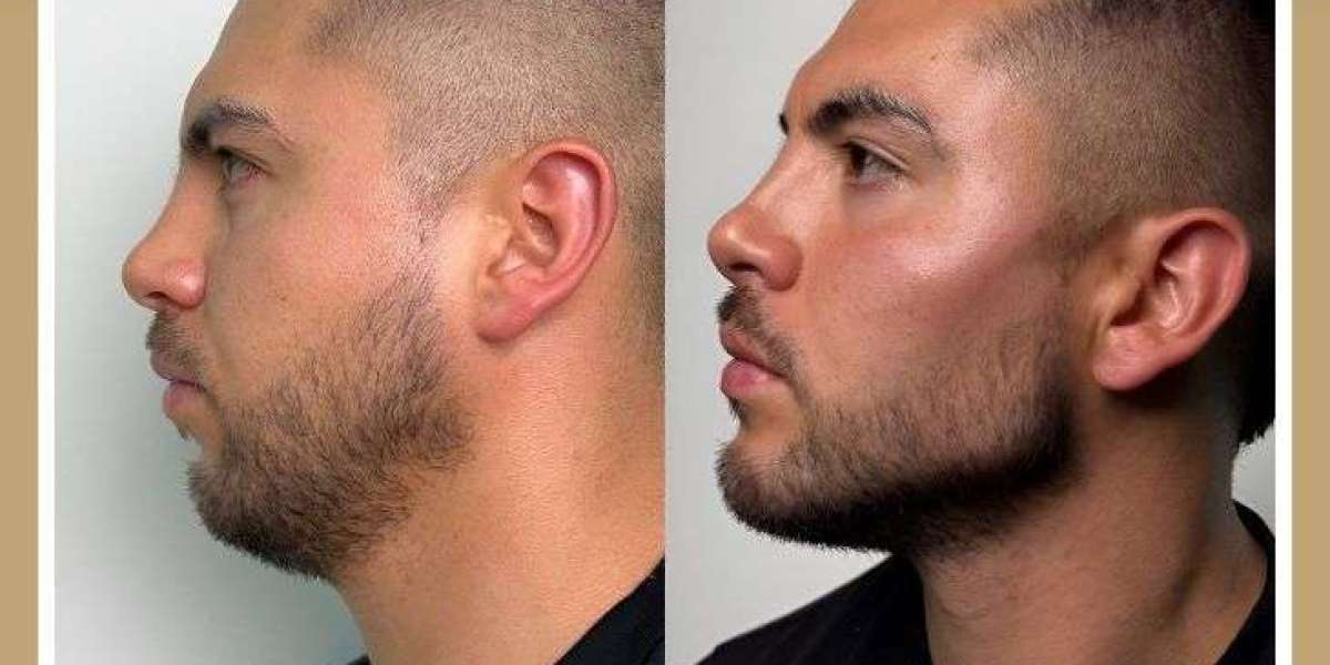 Orthognathic Jaw Surgery in Islamabad – Restore Balance and Function to Your Face