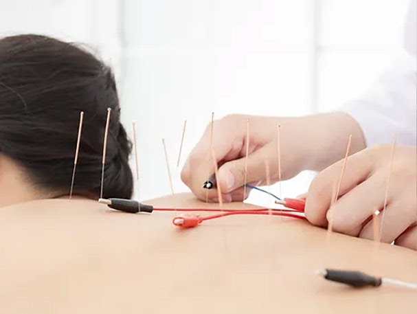 Acupuncture for Stress Relief in RR Nagar
