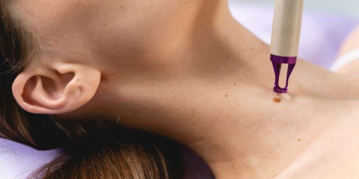 Mole Removal Without Surgery – Safe and Painless Techniques