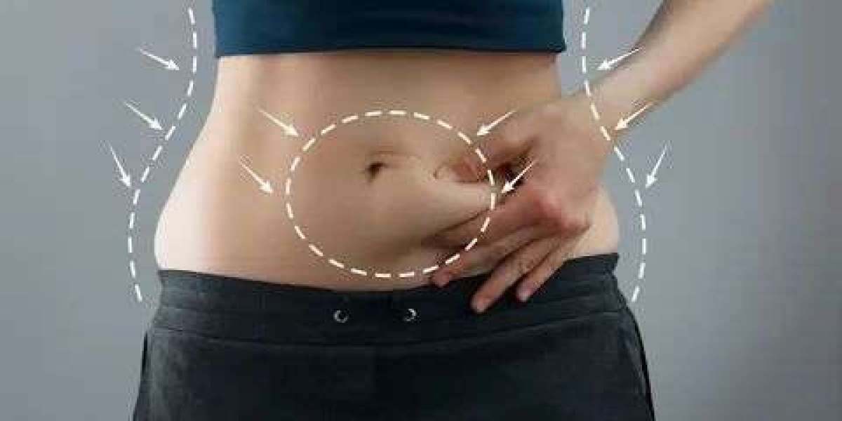 Liposuction in Islamabad – Achieve a Slimmer, More Defined Body