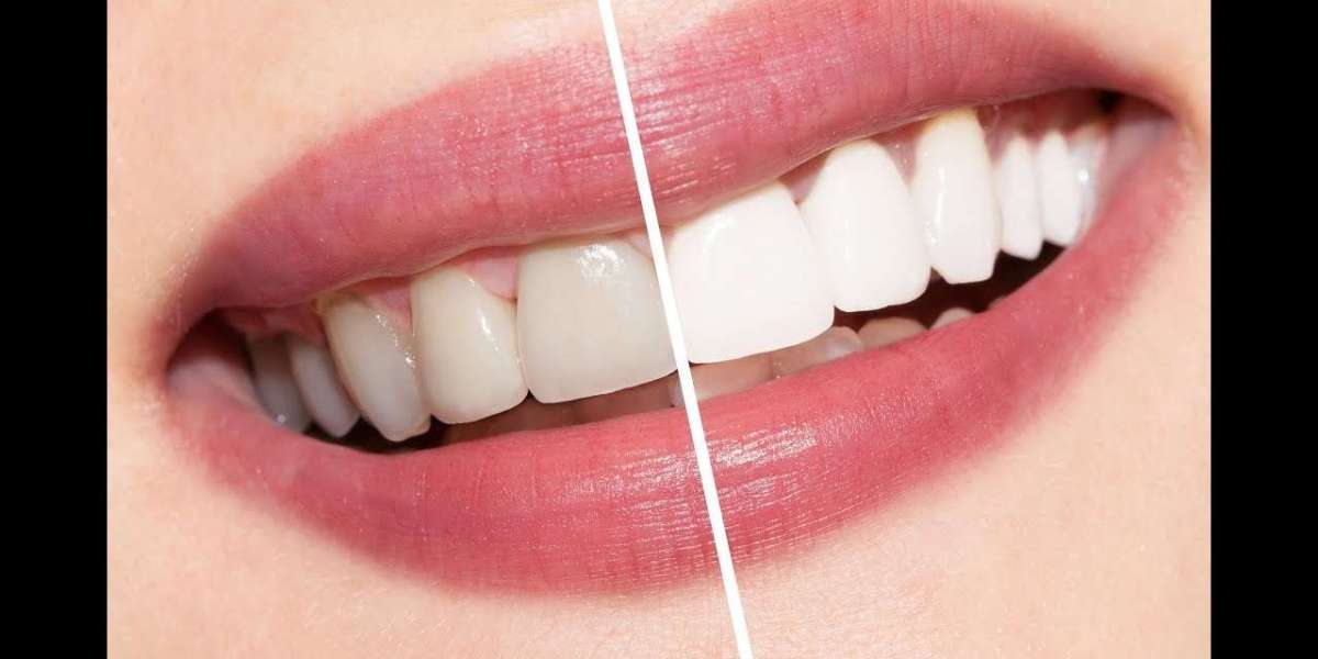 Zoom Laser Whitening Services in Islamabad