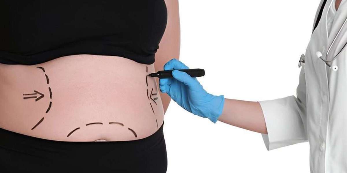Can Bariatric Surgery Help with PCOS and Hormonal Imbalance?