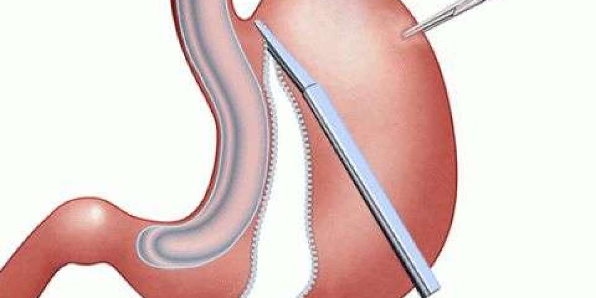 Bariatric Surgery in Islamabad: A Medical Breakthrough for Obesity Control