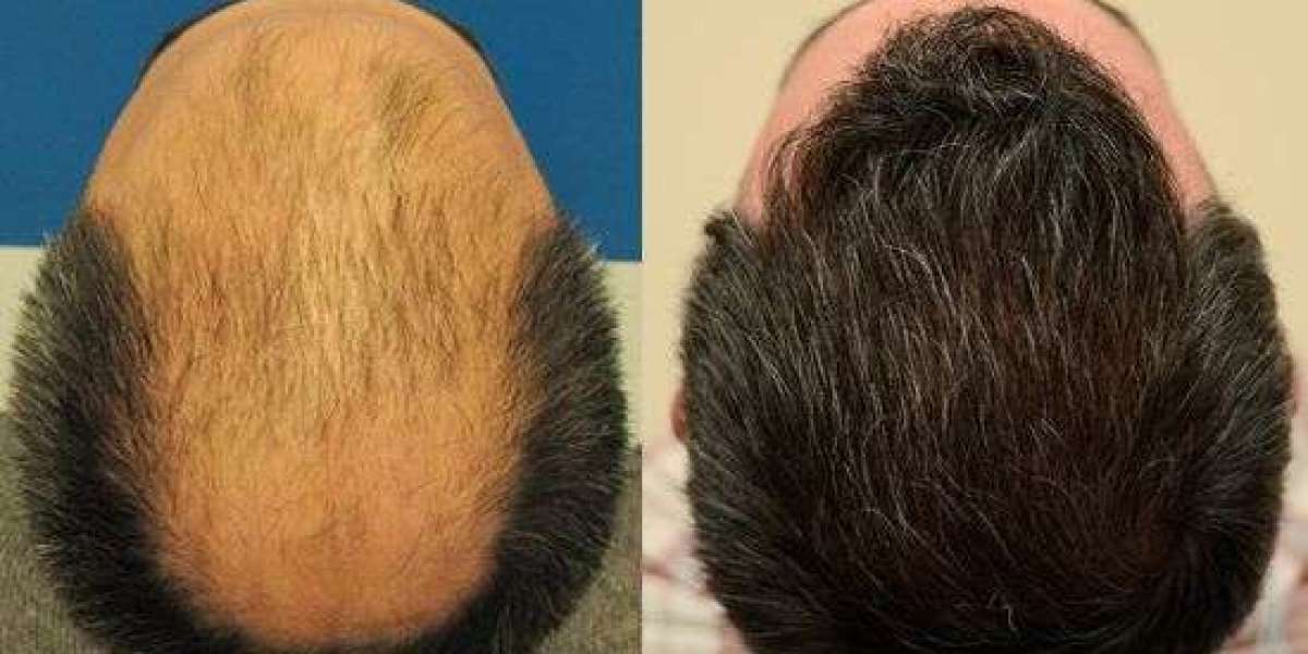 Get Back Your Hair with Advanced Hair Transplant Surgery in Islamabad