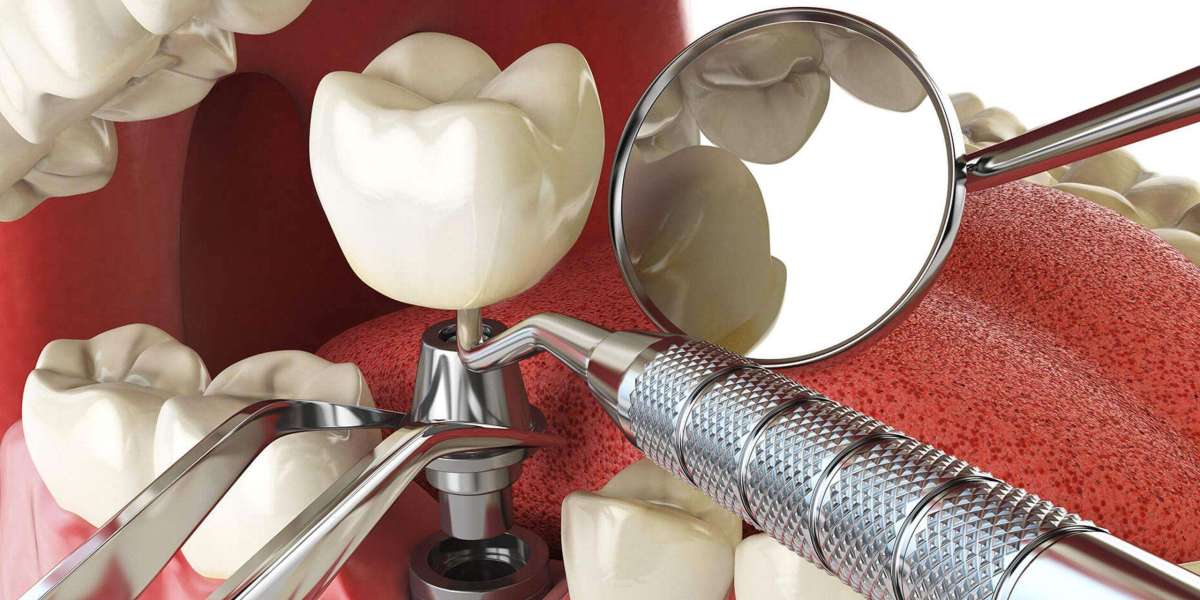 The Role of 3D Imaging in Dental Implant Procedures in Glendale