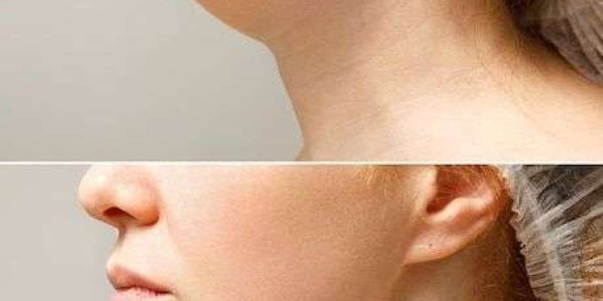 Enhance Facial Symmetry and Function with Jaw Surgery in Islamabad