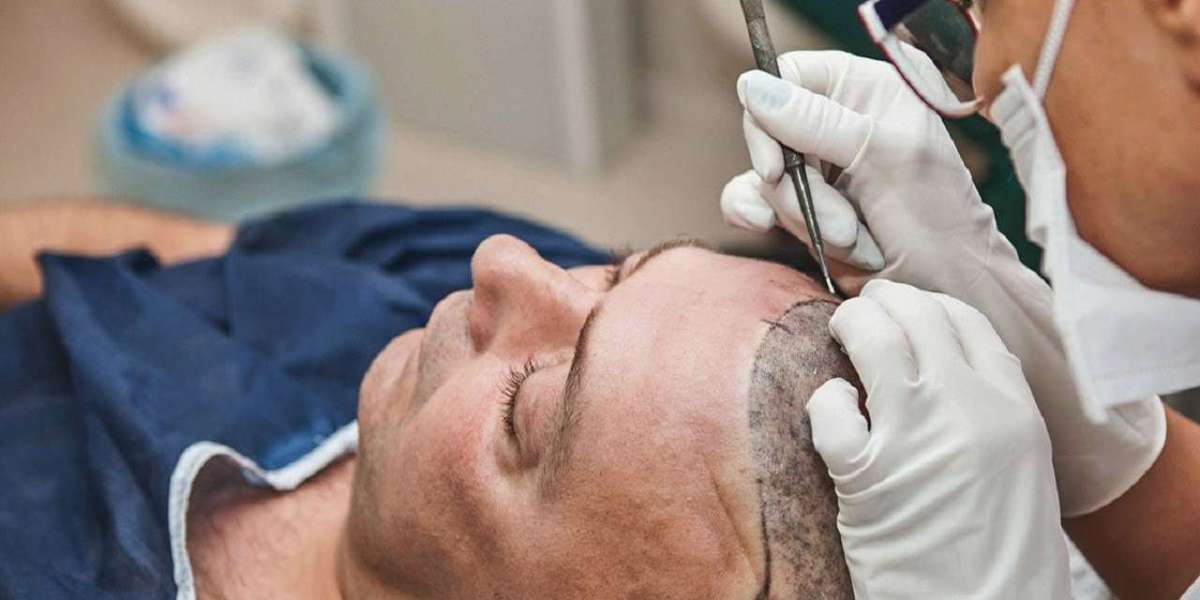 Transform Your Look with a Natural and Permanent Hair Transplant in Islamabad