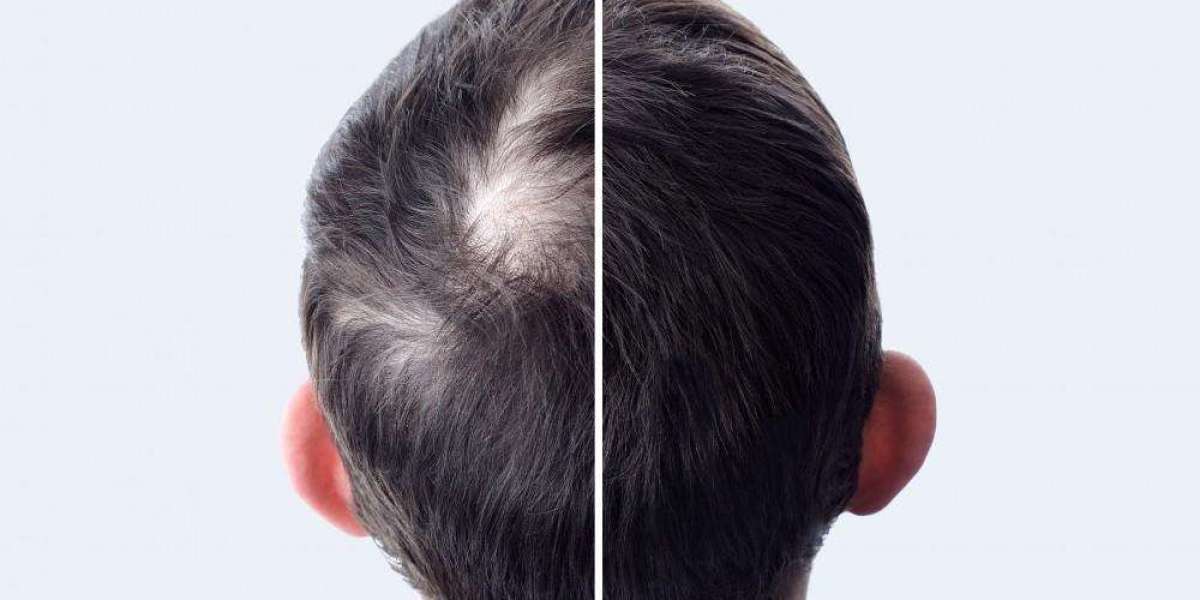 The Science Behind Hair Transplants: How FUE and FUT Really Work