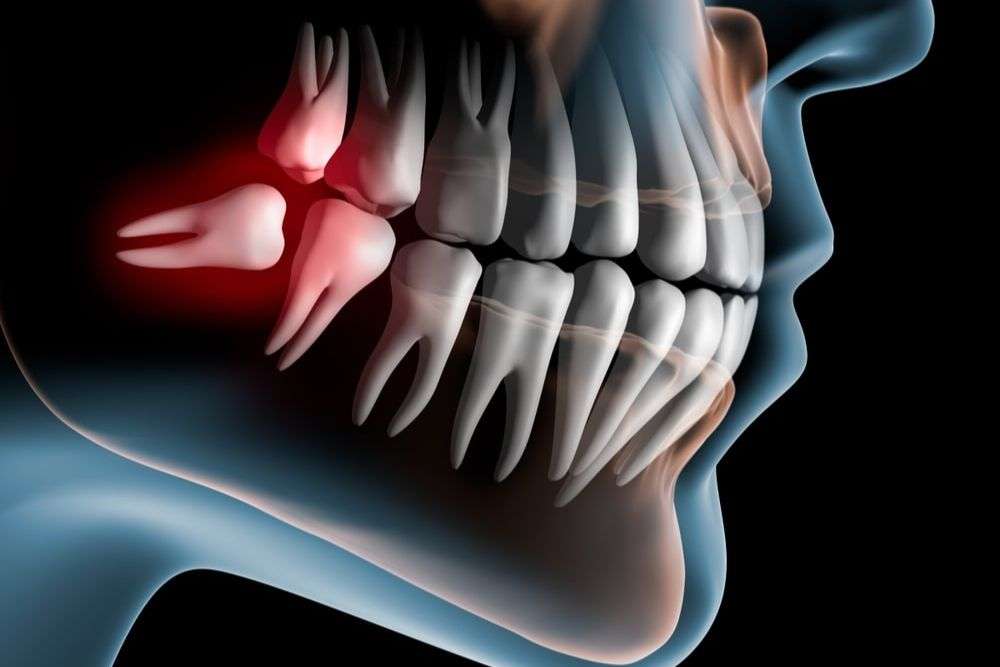 dental implant Leeds 