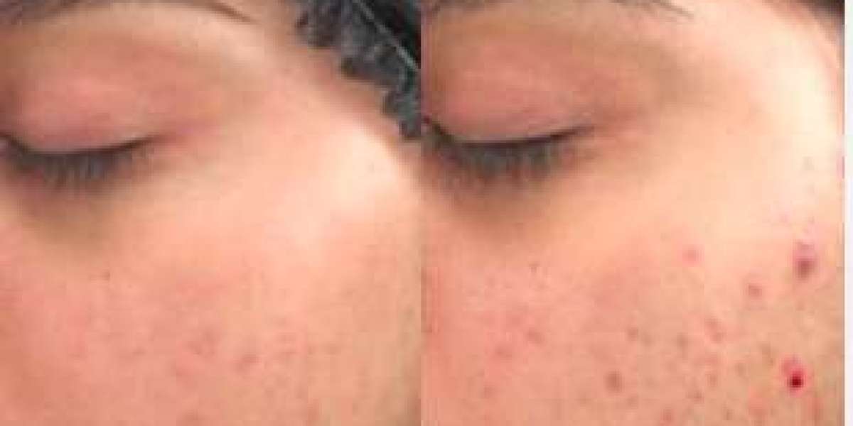Erase Acne Scars & Large Pores: Your Guide to Microneedling in Islamabad