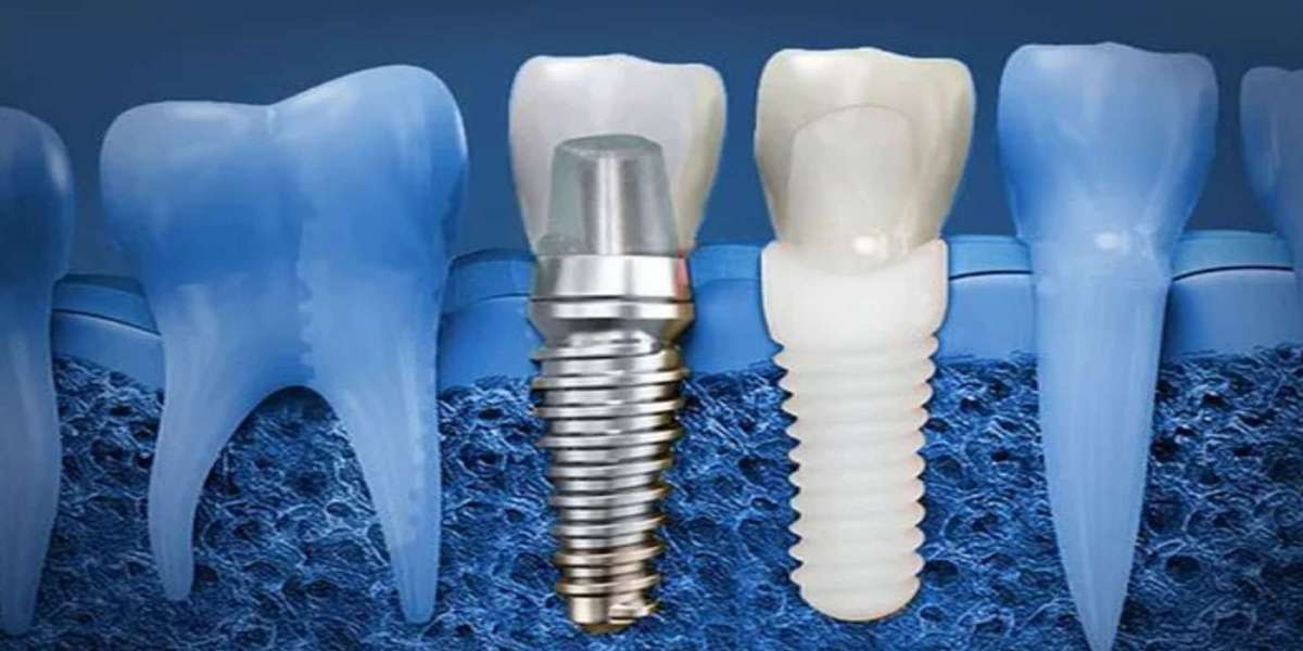 Why Visiting a Dental Implants Clinic in F7 Is the Best Solution for Missing Teeth