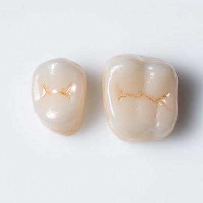 Dental crown in Islamabad Pakistan - ERCs