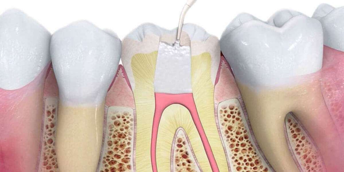 Save Your Tooth with Expert Root Canal Treatment In Islamabad
