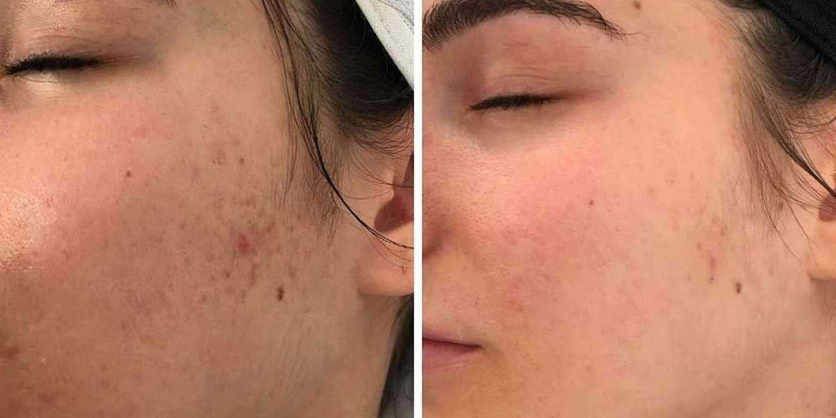 Microneedling for Acne Scars in Islamabad