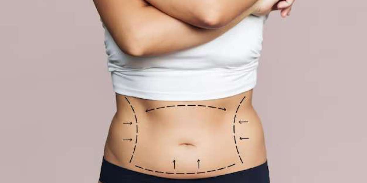 Top Mistakes People Make Before Getting Liposuction in Islamabad