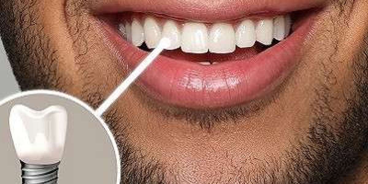 Dental Implants in Islamabad – The Science of Modern Tooth Replacement