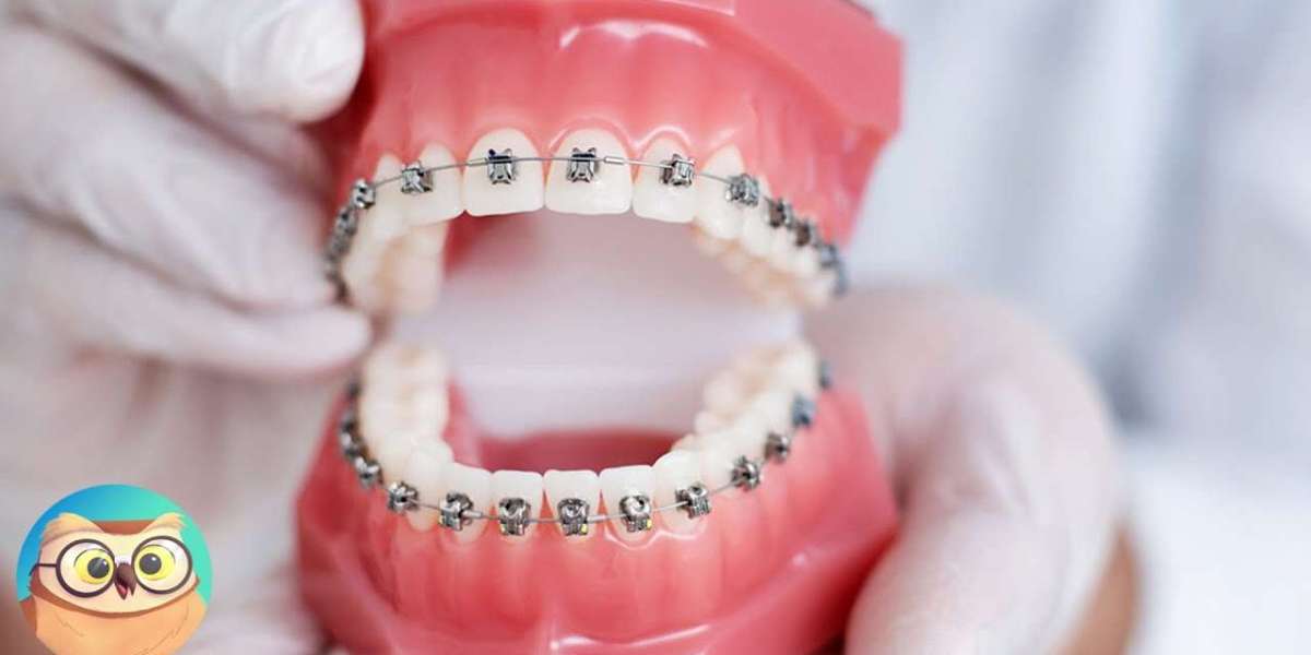 Achieve a Straighter Smile with Dental Braces in Islamabad