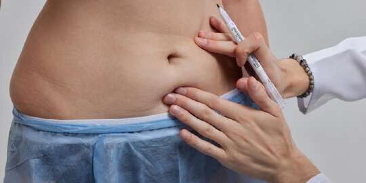 Achieve a Toned Body with Liposuction in Islamabad