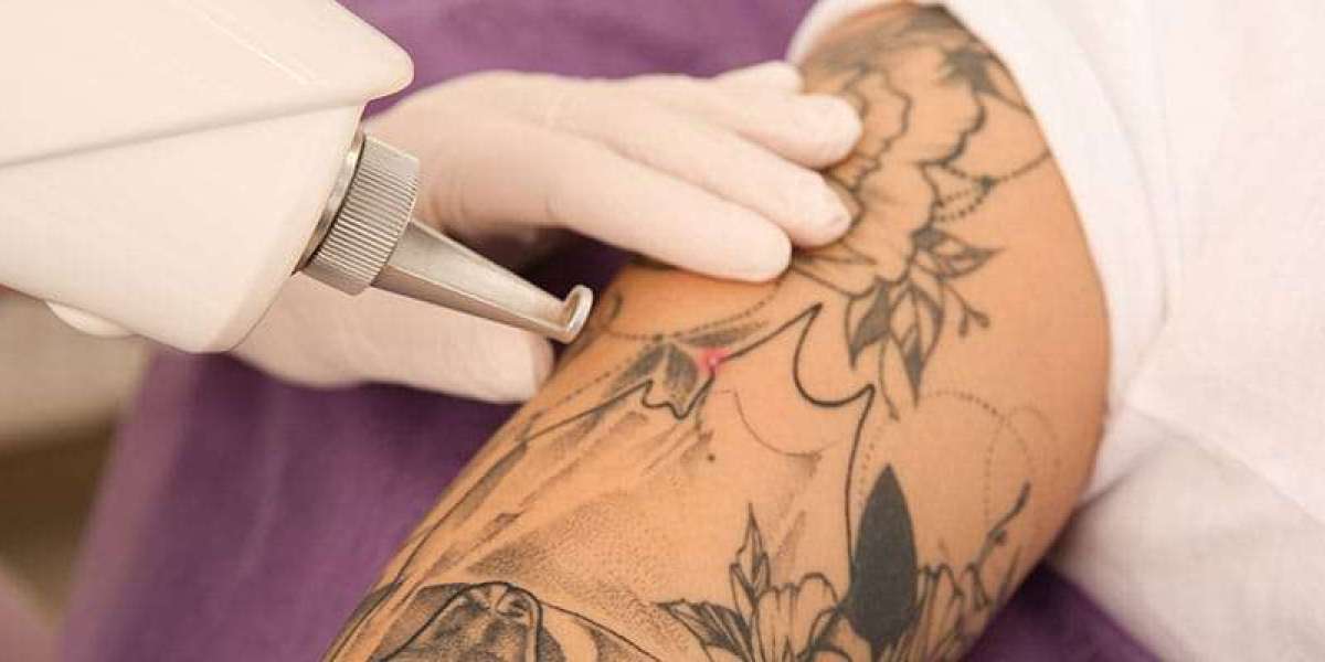 Liberate Your Skin Non-Surgical Tattoo Removal for a Fresh Start