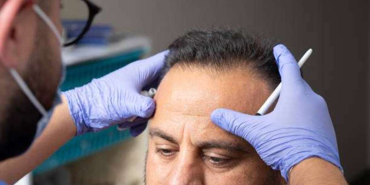 Can Hair Transplants Treat Patchy Hair Loss?