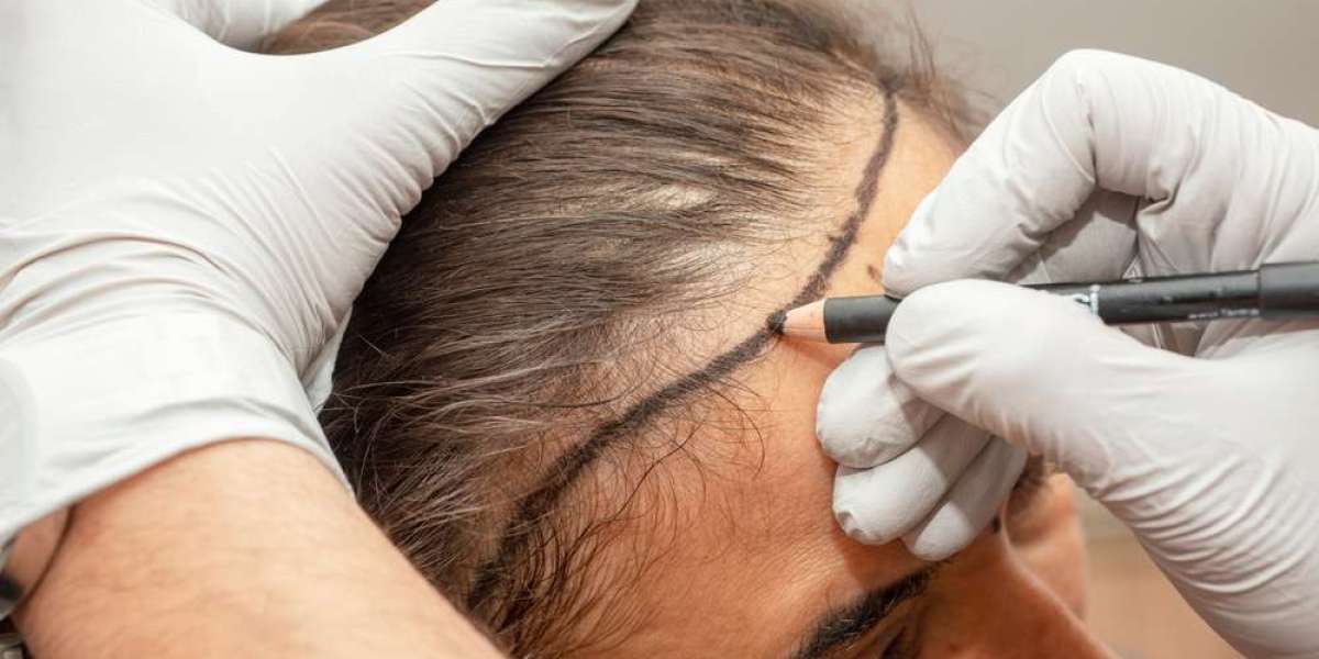 Scalp micropigmentation vs hair transplant: which is better in Islamabad?