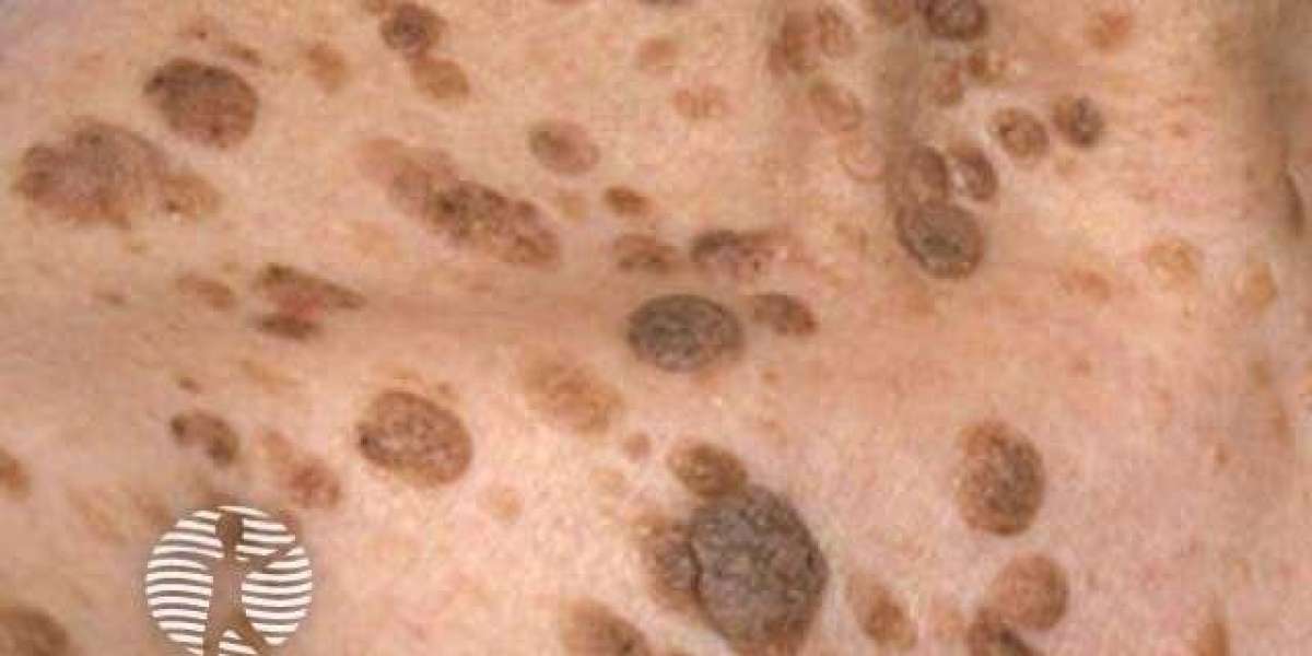 Is It a Wart or Something Else?