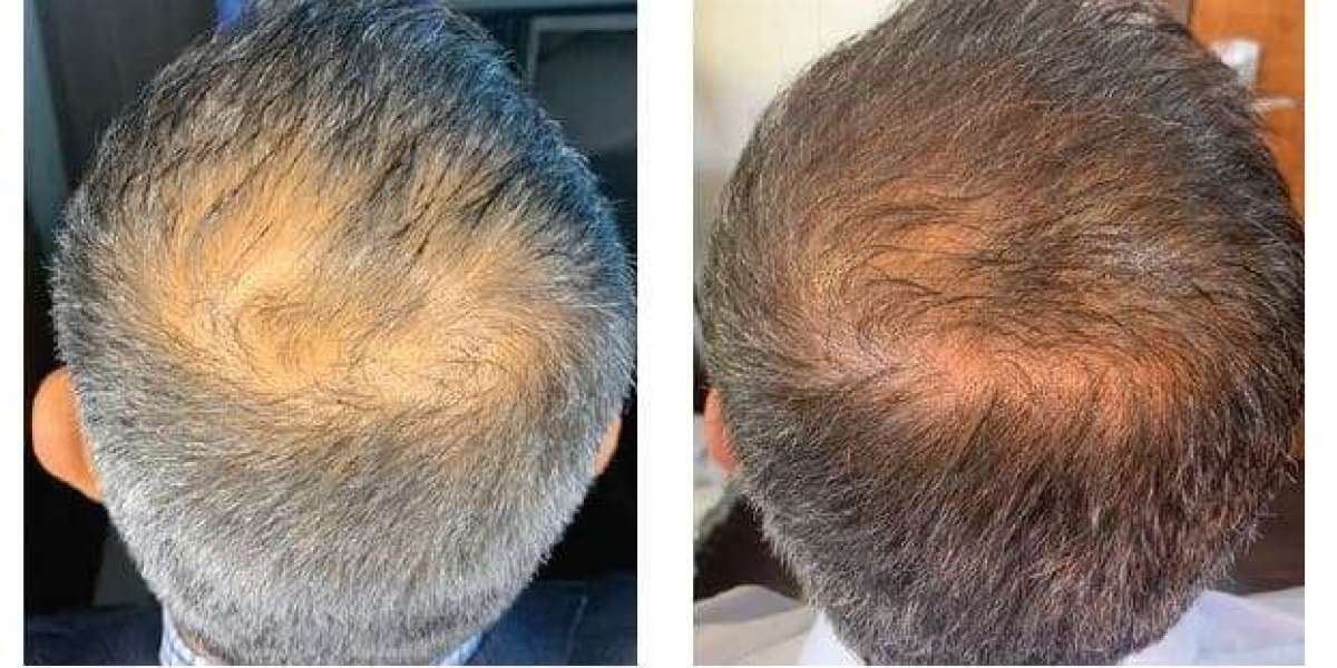 Targeted Repair Injecting Exosomes for Precision Hair Regrowth in Saudi Arabia