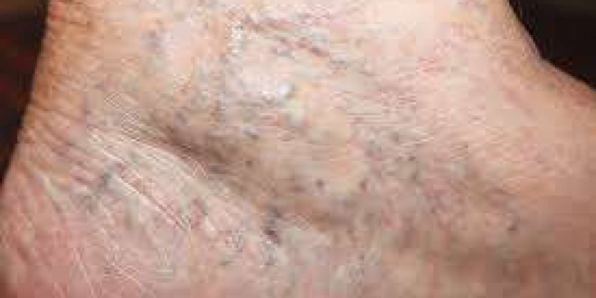 What Is the Recovery Time for Spider Vein Treatment?