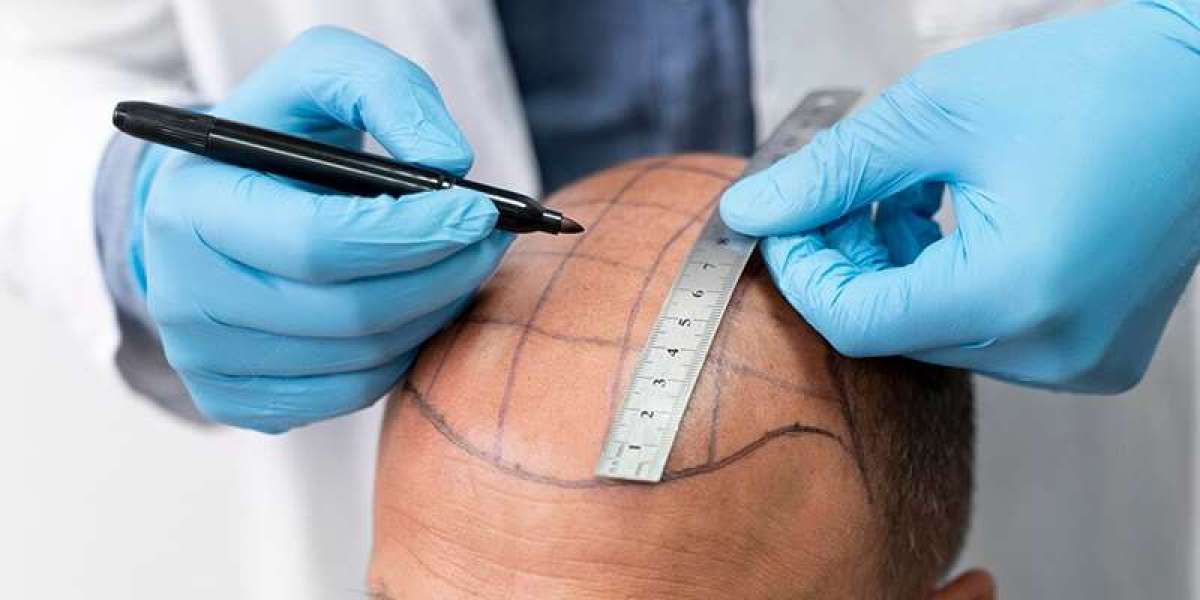 Hair Transplant Recovery: Tips for Faster, Better Results