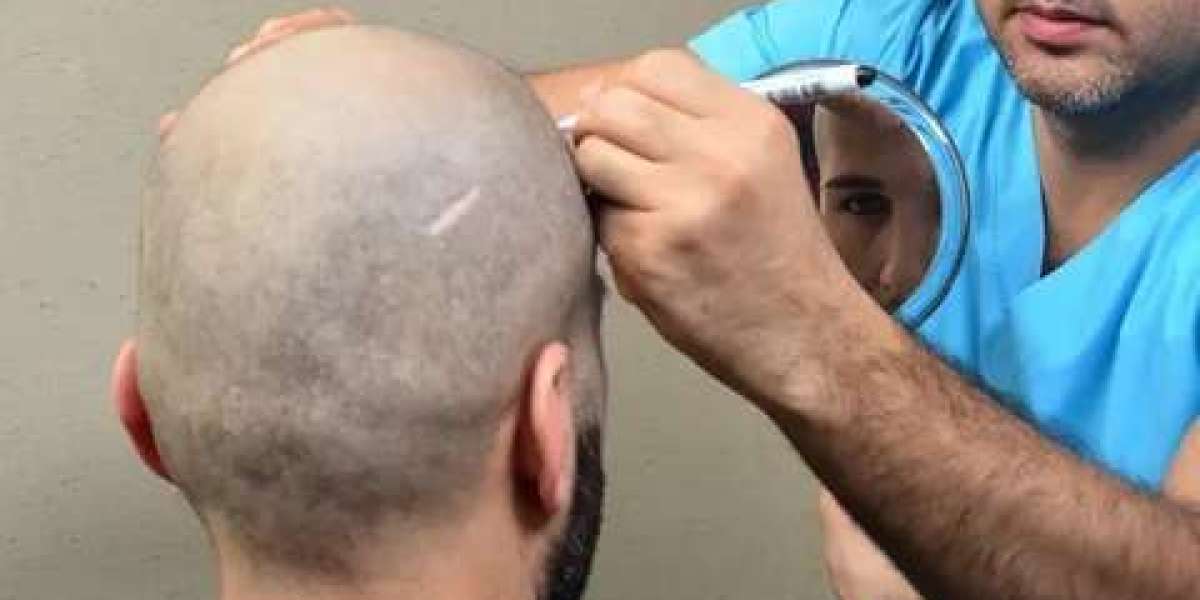 Hair Transplant in Riyadh: A Complete Guide to Restoring Natural Hair