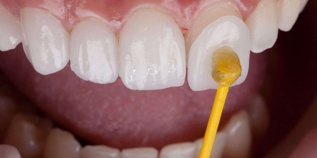 Instant Smile Transformation: Veneers in Islamabad