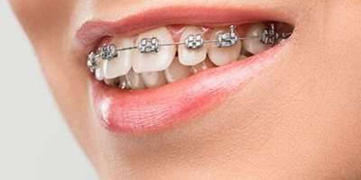 What Foods Should I Avoid During Orthodontic Treatment?