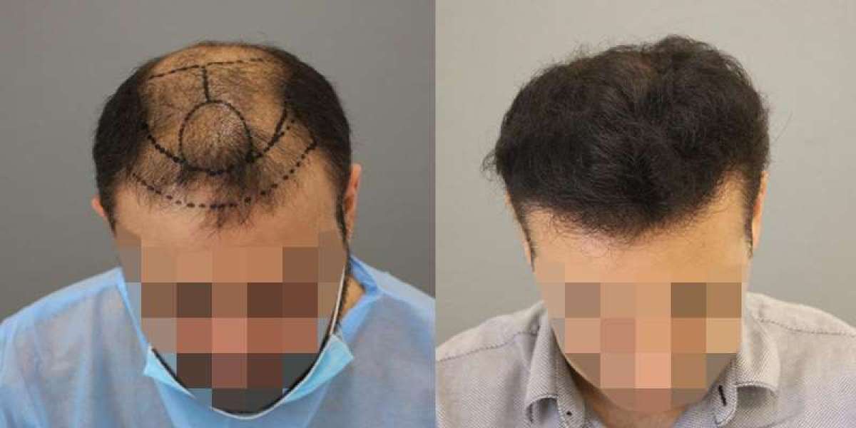 Hair Transplant in Abu Dhabi: Top Reasons to Consider It