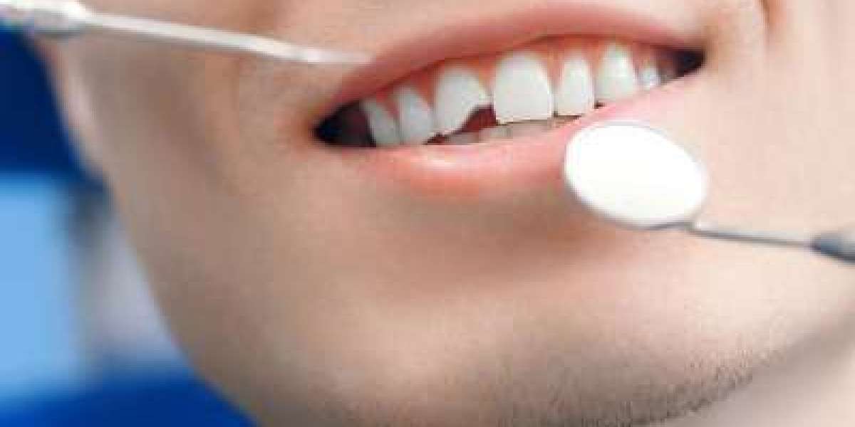Advanced Tooth Fracture Treatment in Islamabad for Severe Damage