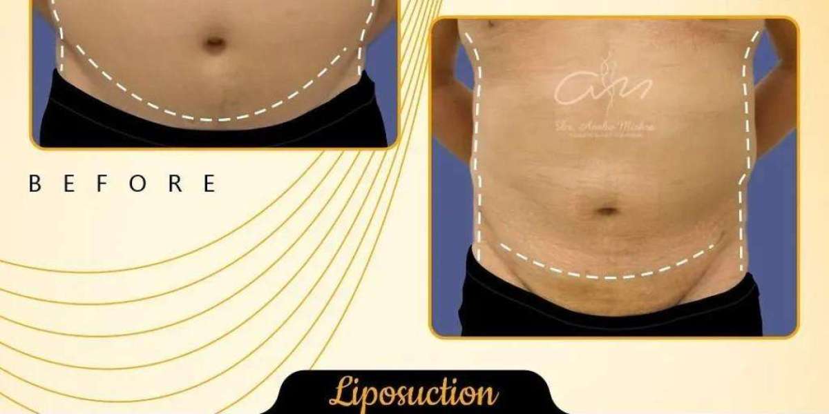 Advanced Liposuction In Dubai by Dr Anshu Mishra | Best Plastic Surgeon in Dubai
