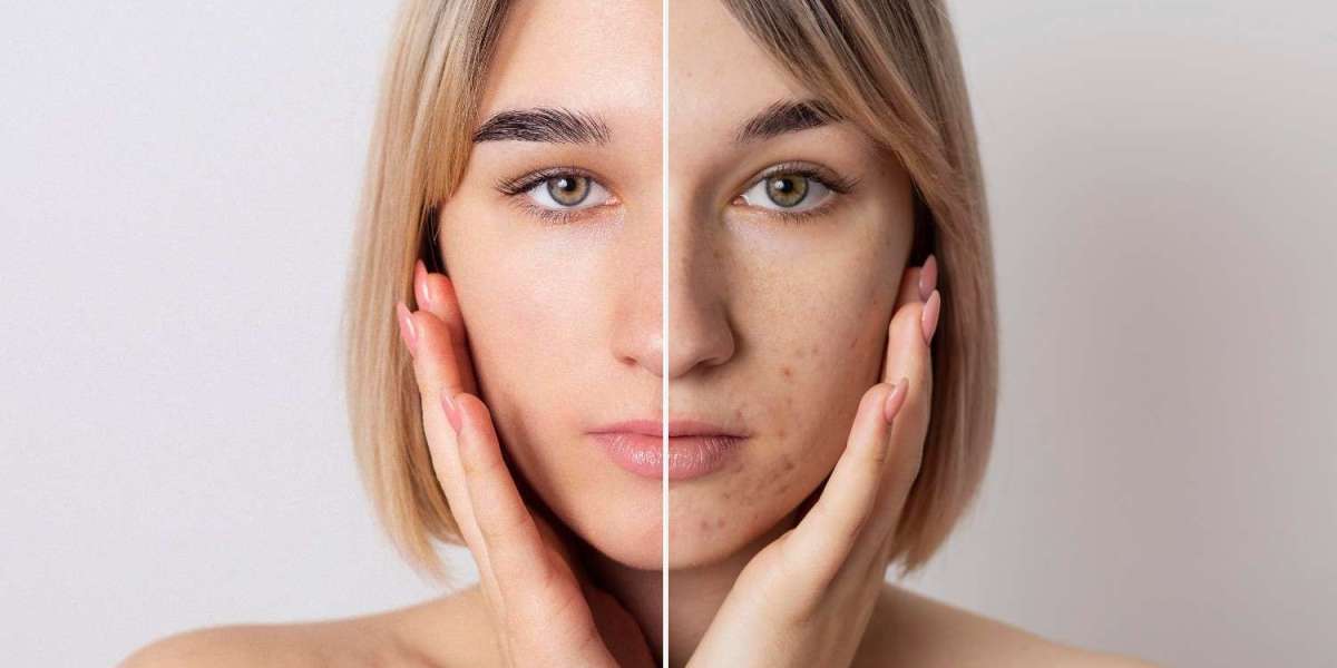 Pigmentation Treatment in Delhi – Dr Prakash Kumar Khute | Skin Roots Clinic