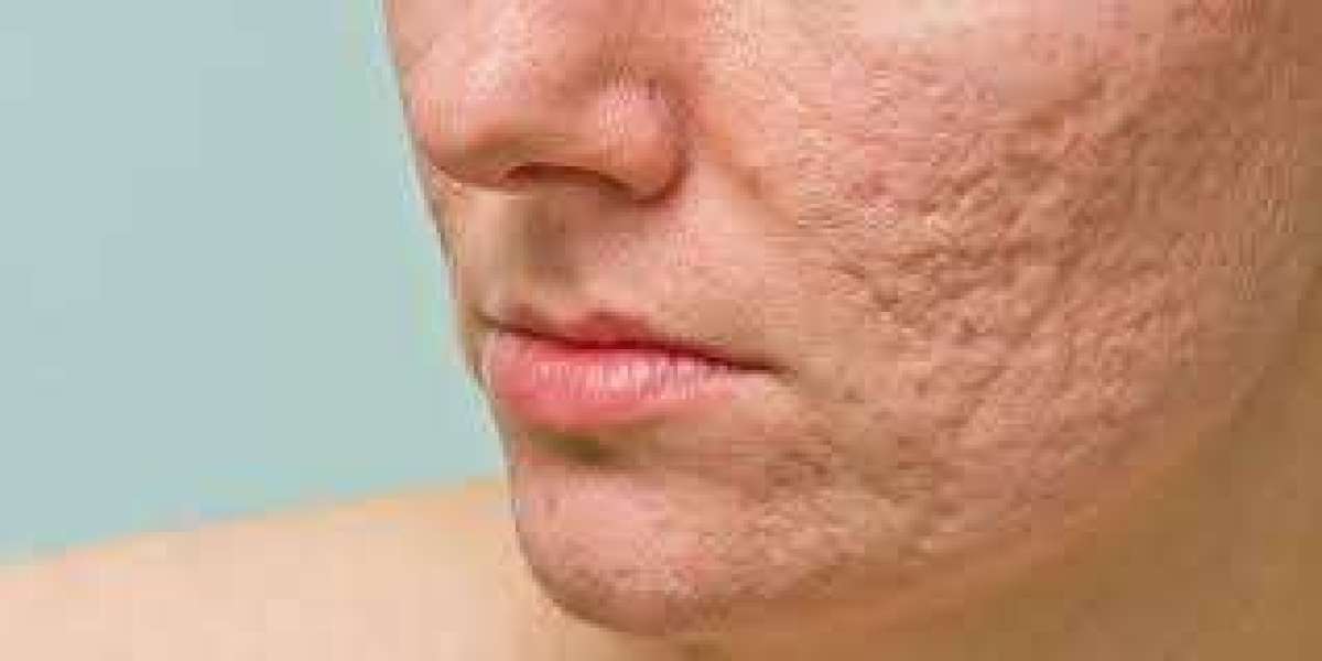Managing Pimple Scars Effectively