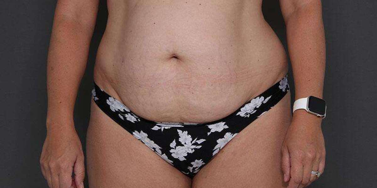 Mini Abdominoplasty for Lower Belly Tightening