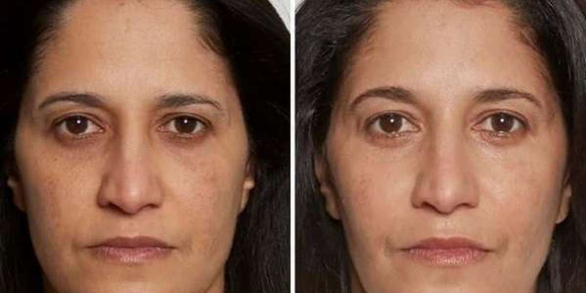 Radiesse or Sculptra? Tailoring Fillers to Your Needs