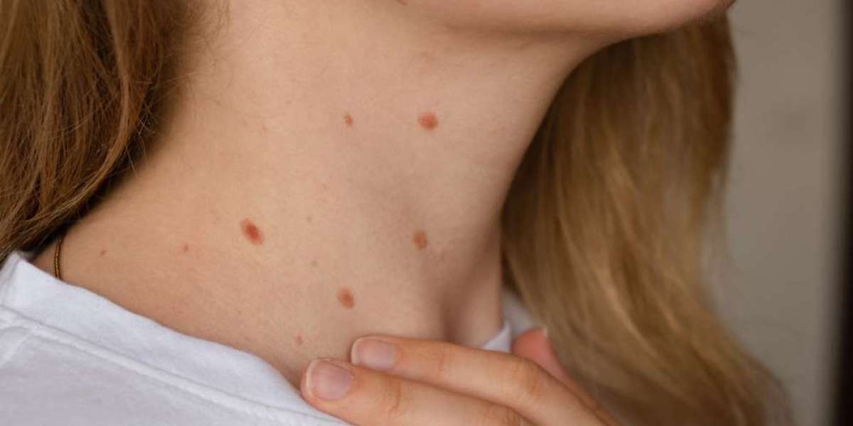 Are Skin Tags Contagious? Insights from Dermatologists